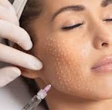 Mesotherapy